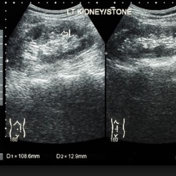 Kidney stones
