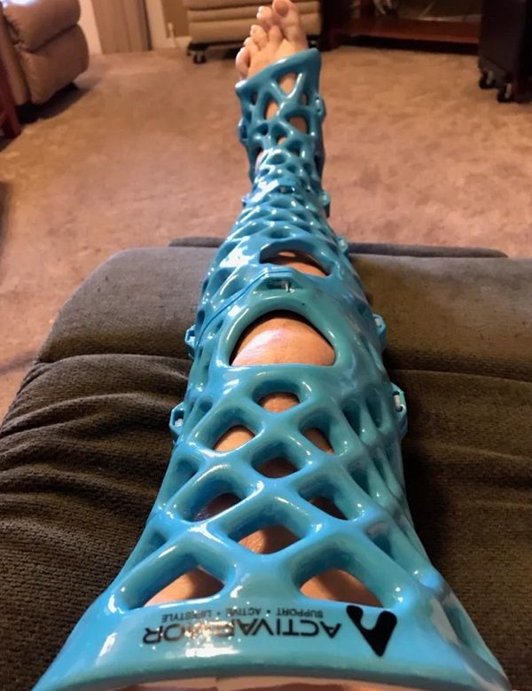 ActivArmor 3D Printed Casts