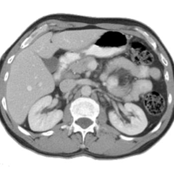 X-Ray Tomography