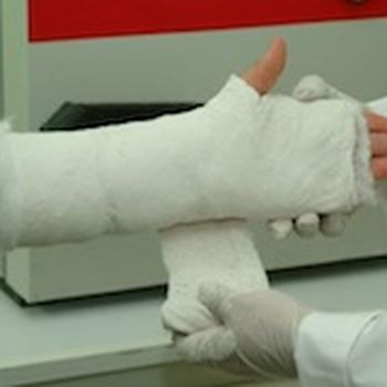 Pre-deposited blade in a plaster cast
